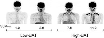 Brown fat-associated postprandial thermogenesis in humans: Different effects of isocaloric meals rich in carbohydrate, fat, and protein